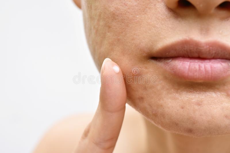 A woman's face which is highlighting the source of acne problem.