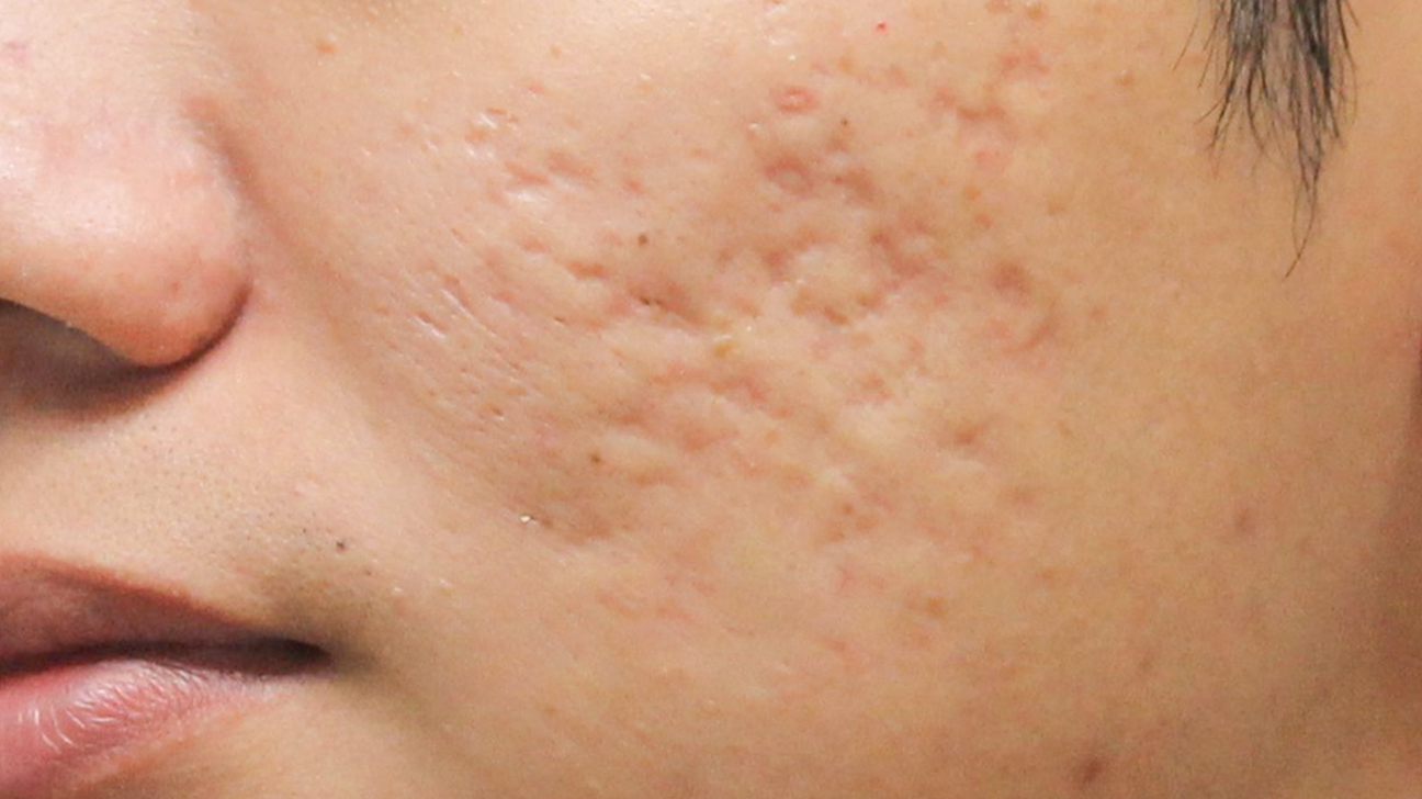 A skin with acne scar