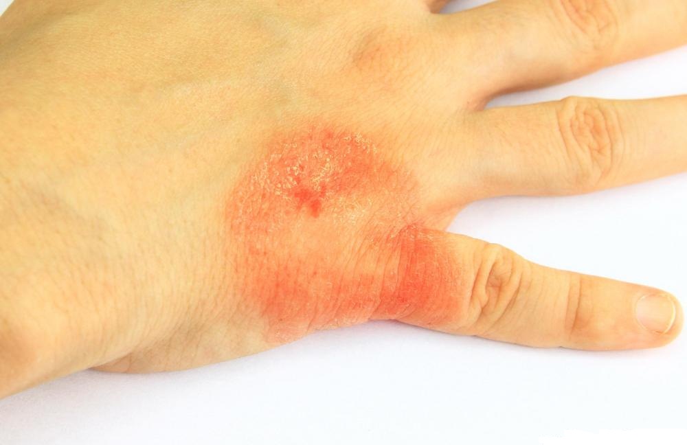 A hand with visible skin allergy reaction