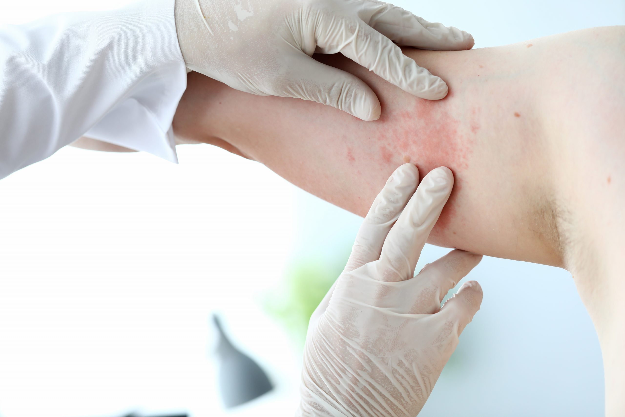 Treatment for skin cancer conducted by a doctor